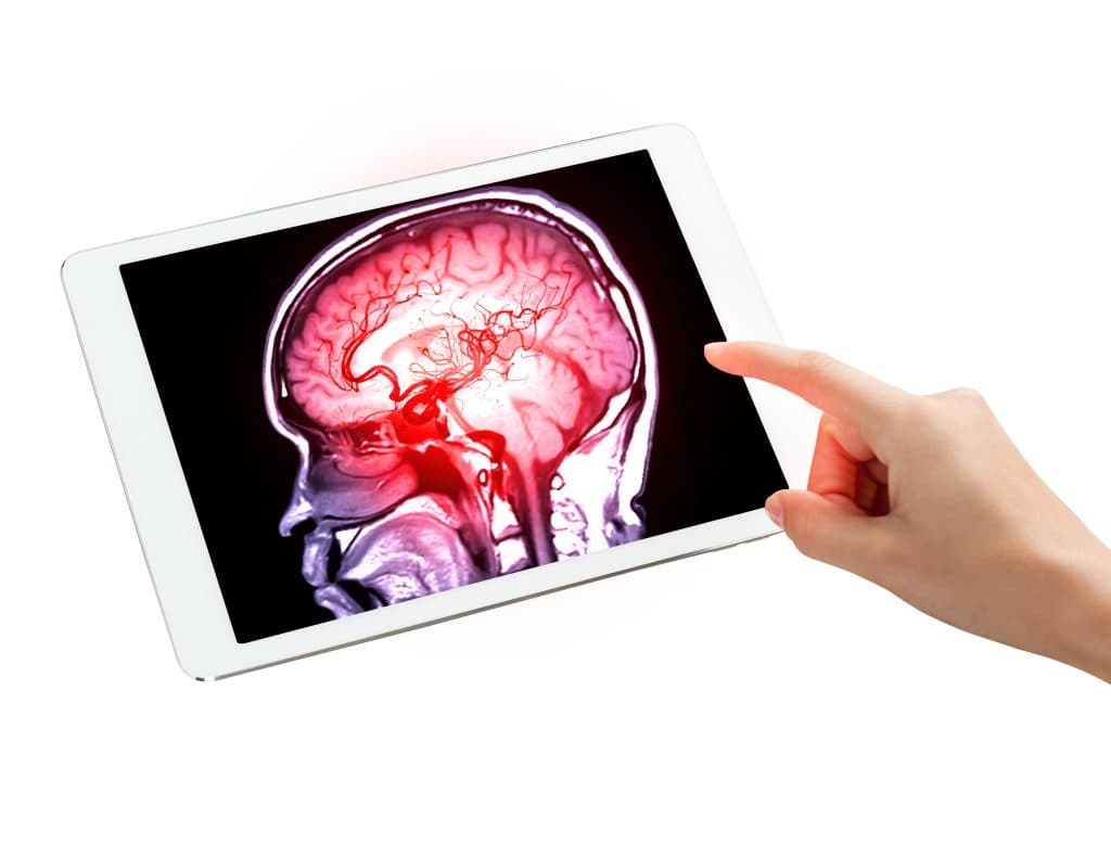 Strokes and Dementia: What You Can Do to Protect Your Brain!